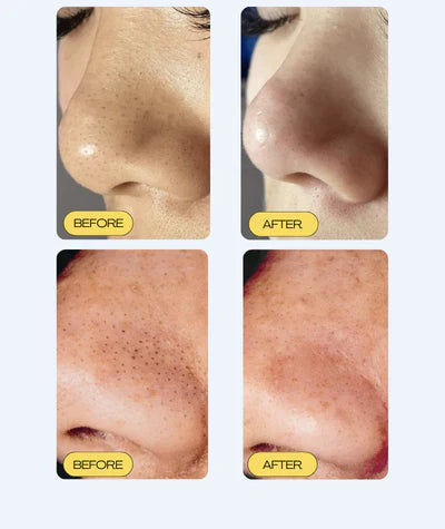 Jalea Skin Mask Limpiadora De Puntos Negros - Gold Honey™